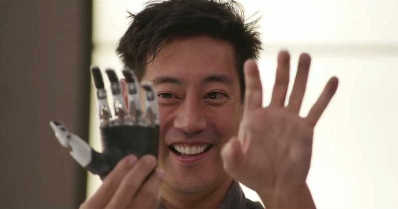 Angel's bionic arm retails for $30,000