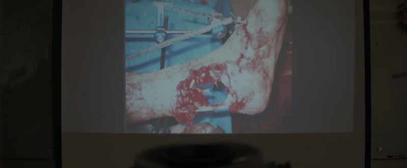 Based on the bite radius and the tear direction