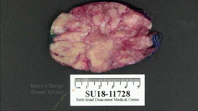 Benign tumour