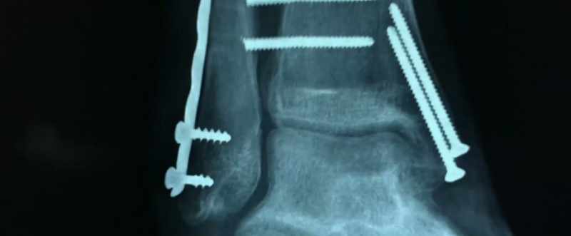 Broken bones, gunshot wounds, stab wounds
