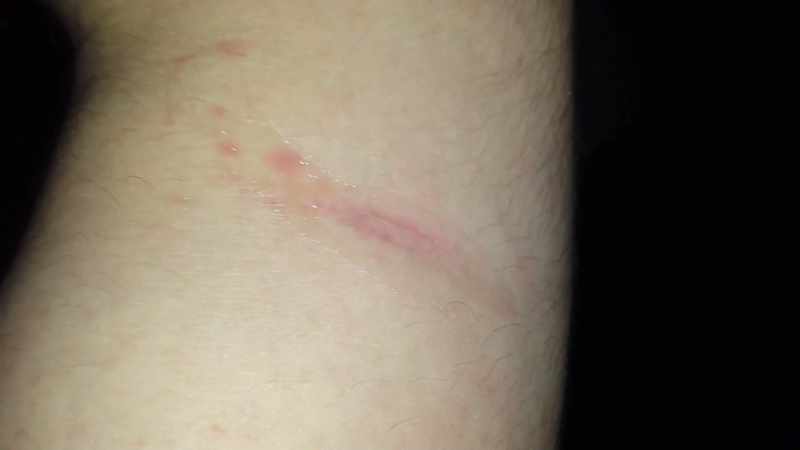 Burn update. It's not getting any better