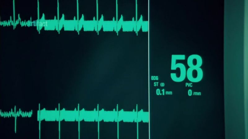 Burst suppression alpha coma