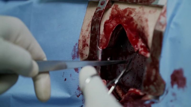 Cutting the pericardium, exposing the heart