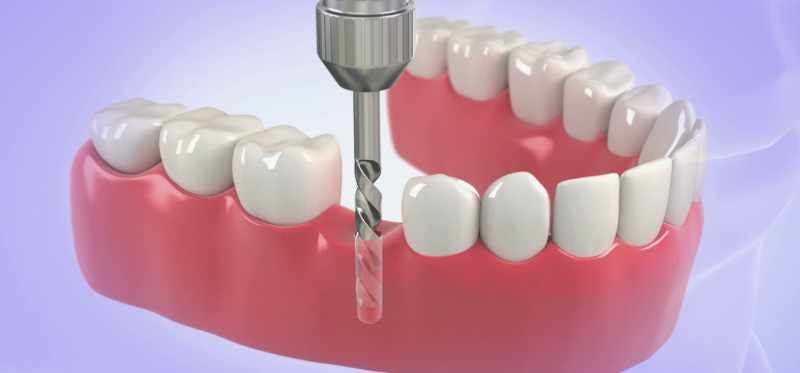 [Dr. Breiner] An implant is where you're going