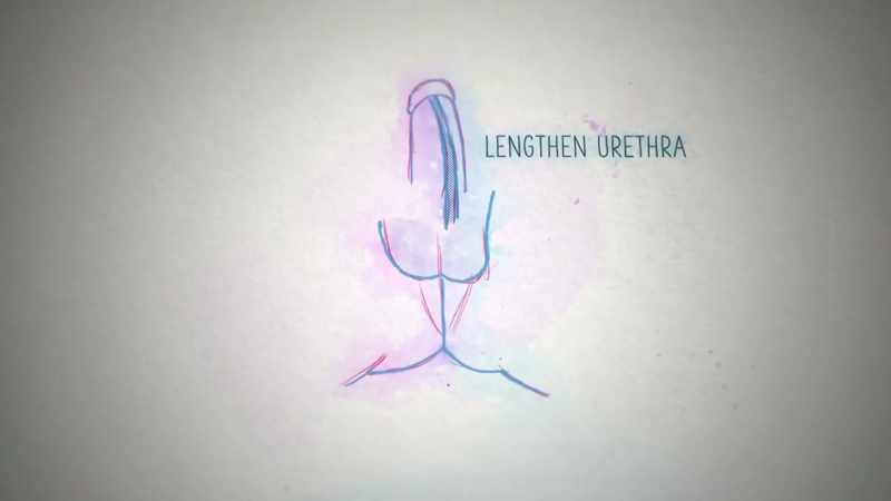 Further surgeries may involve lengthening the urethra, creating