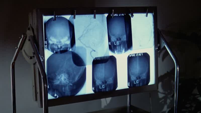 Dr. Taney says the x-rays are negative. In other words, normal