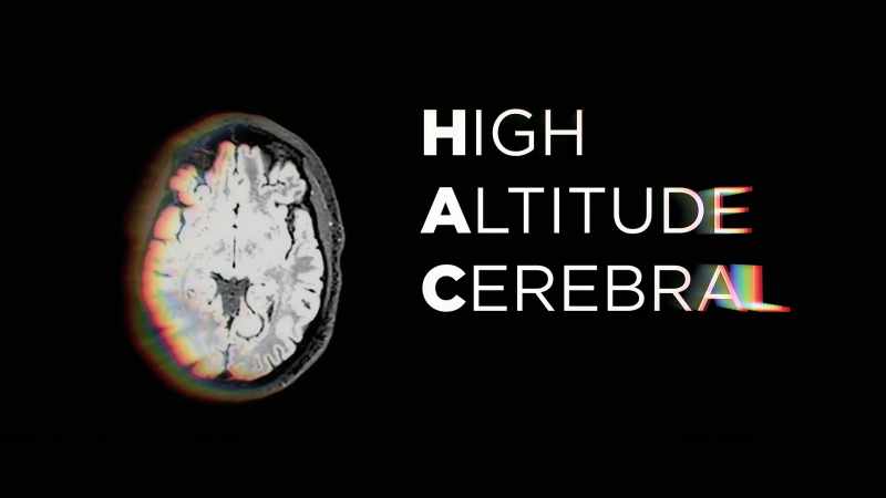 HACE is high-altitude cerebral edema
