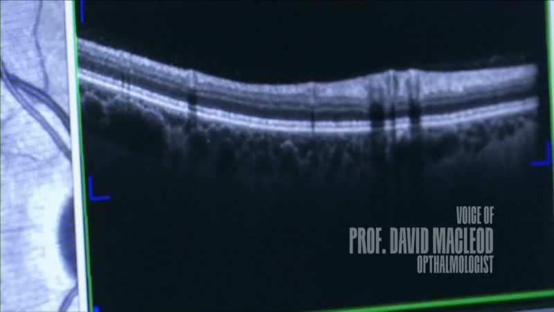He had further surgery which was able to
