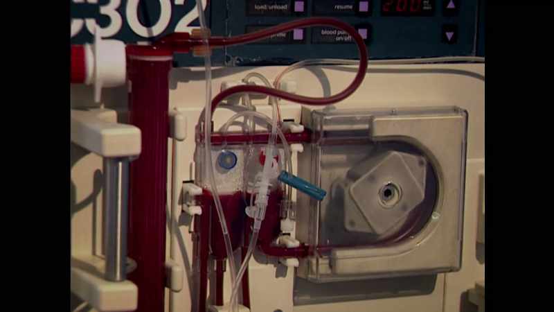 He then started on dialysis