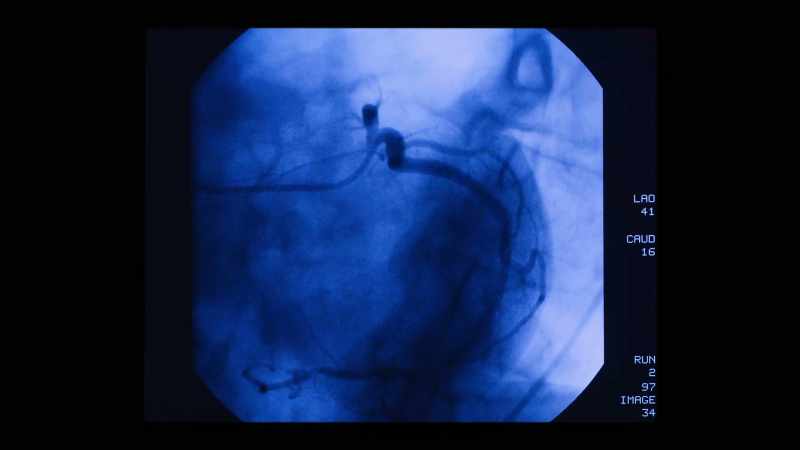 He'd just had a cardiac catheter go wrong