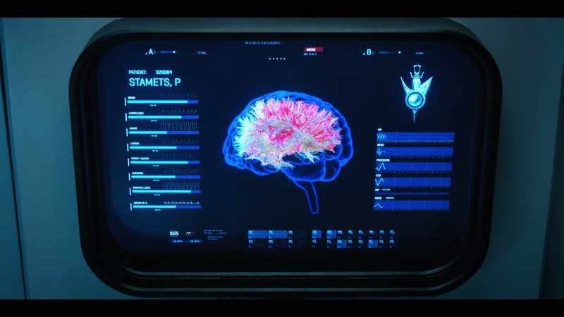 Hyperactivity of white matter in his brain