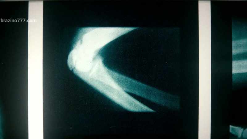 I had a right arm paralyzed, 12 bones broken