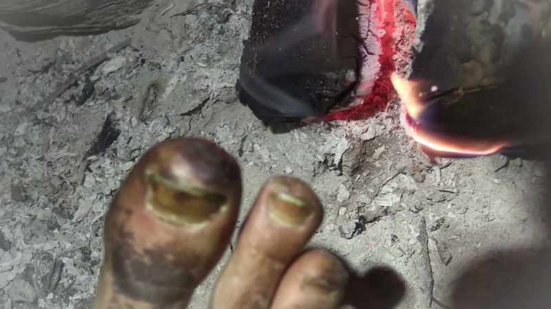 I had frostbite on four of my toes