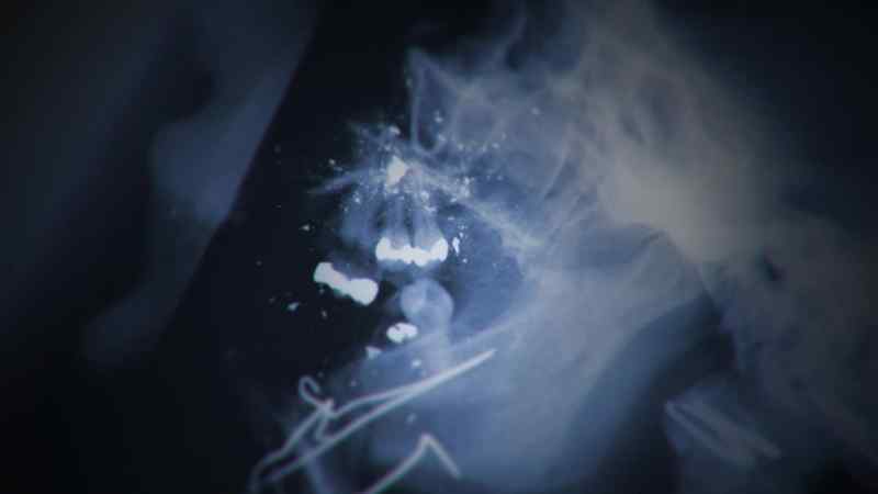 I remember seeing all of her upper molars