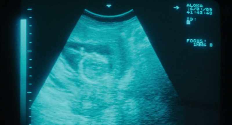I see the baby's head