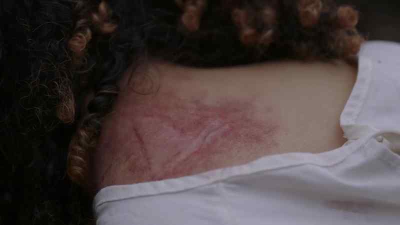 I think the Debris has been implanted under her skin