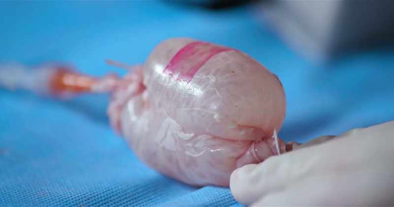 If you have this much pressure in your intestine