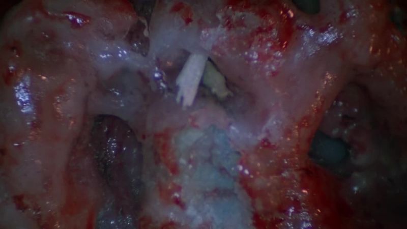 I'm finding fragments of petrous bone