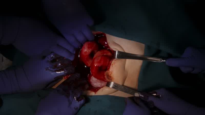 Internal bleeding
