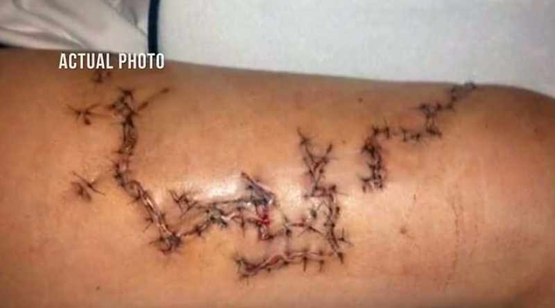 It takes 200 stitches to save her leg