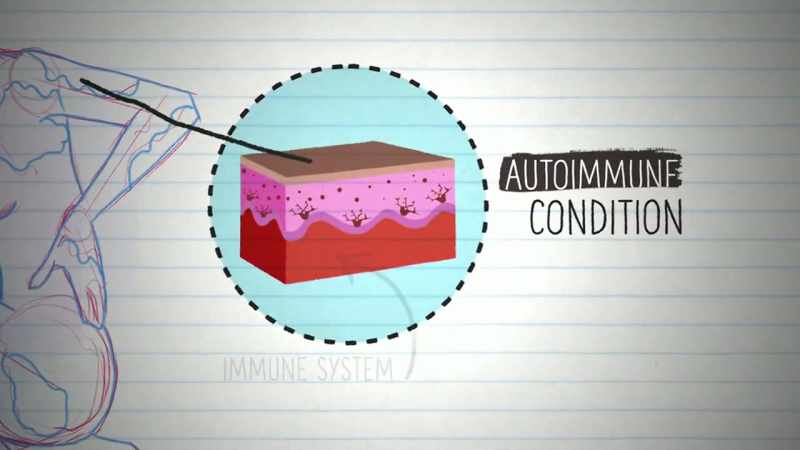 It is thought to be caused by an autoimmune condition
