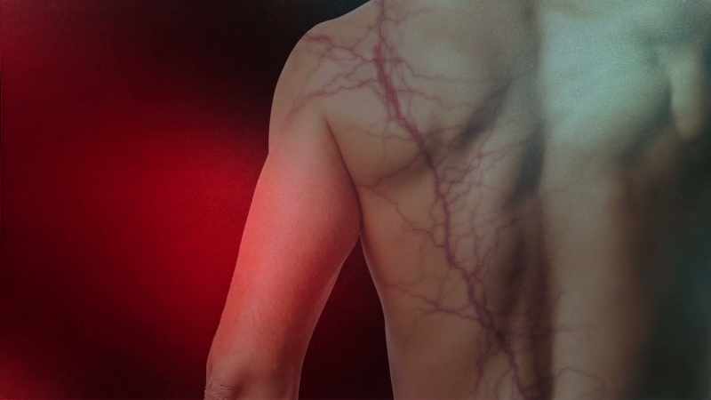It's a Lichtenberg figure, so called, across his back