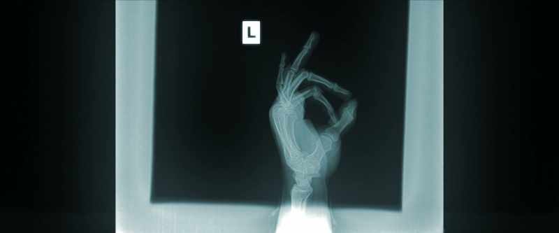 I've broken my right foot, toes, and fingers