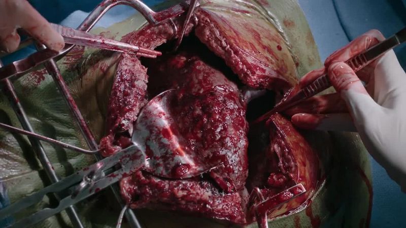 I've never seen a liver this inflamed before, Dr. Sullivan