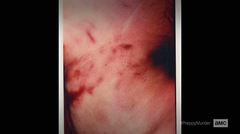 Jennifer Levin had marks on her neck