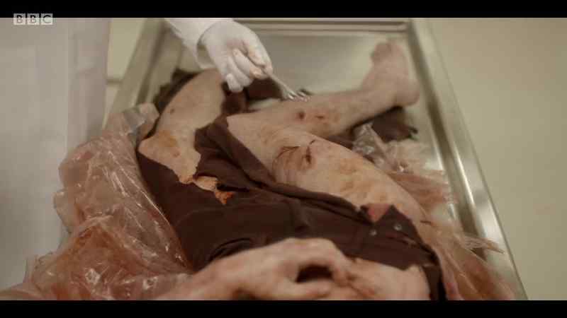 Lacerations on the thigh and upper leg on the right side
