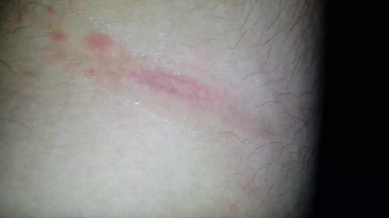 Like the burn on my arm