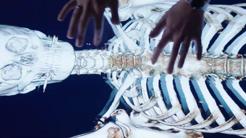 Maybe a slight hairline fracture, but the shape is off