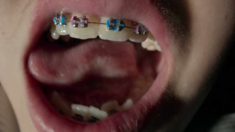 Most orthodontic treatment flattens faces