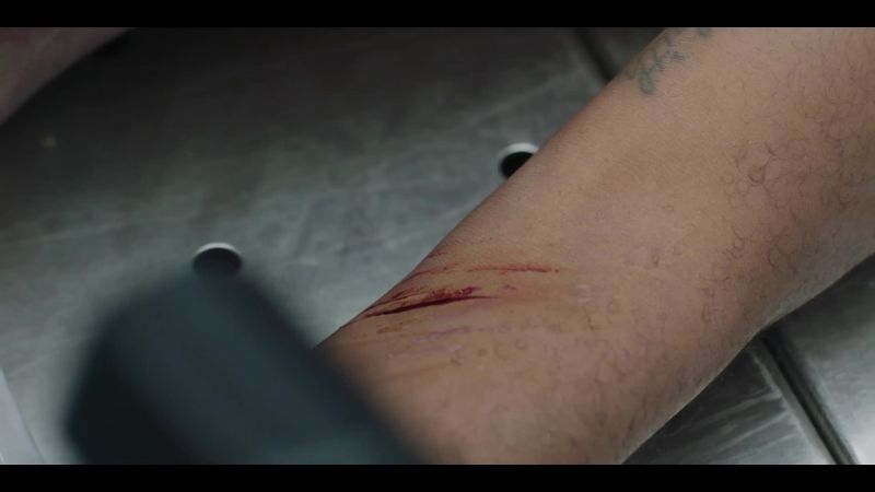 Multiple scars, both forearms, different ages