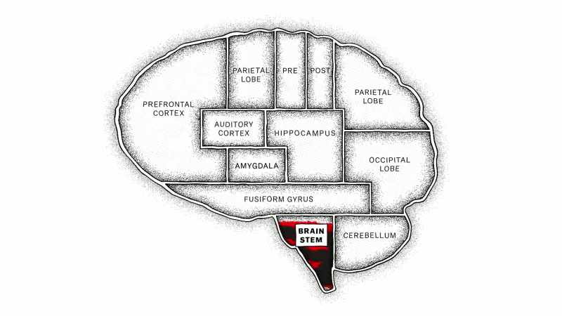 [narrator] In rare cases, that spot in the brain stem