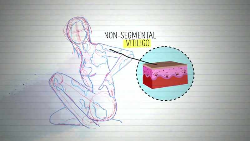 Natalie has a variant called non-segmental vitiligo