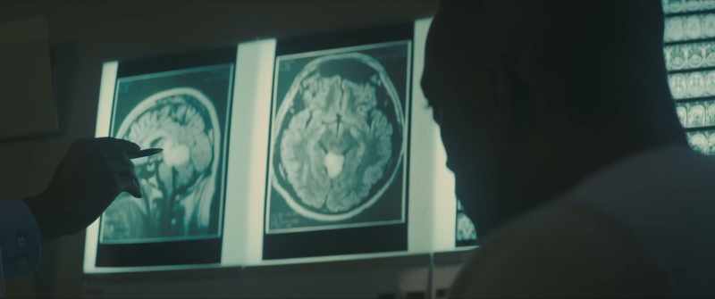 Now usually when there's a tumor in this area, it's inside