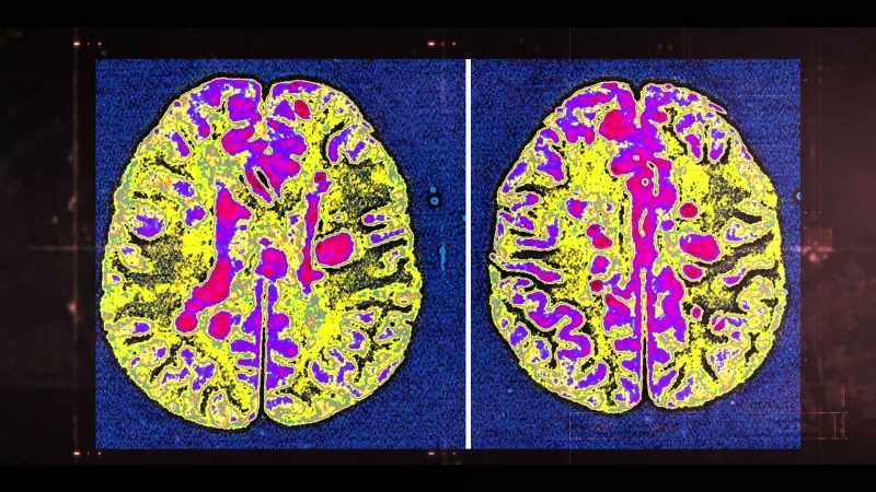 Patches of white matter diseases