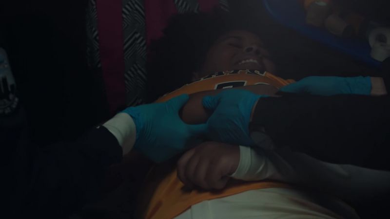 Posterior elbow dislocation