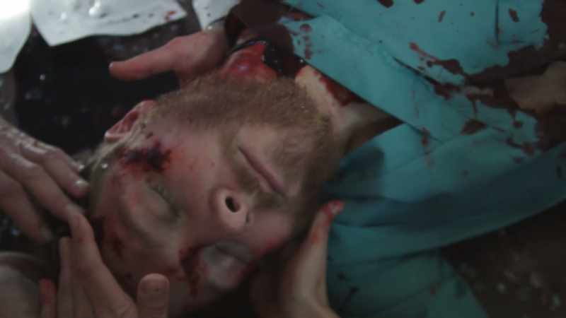 Prolonged extraction time. Some lacerations