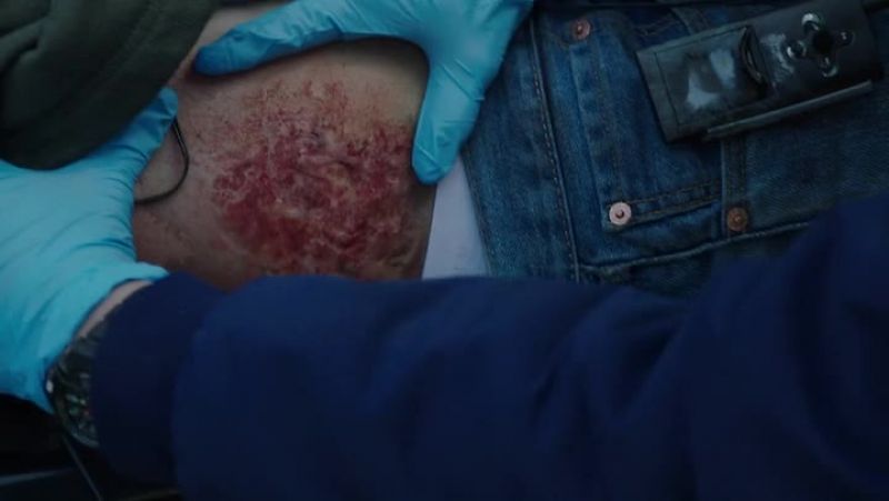 Shay, he's got an electrical burn