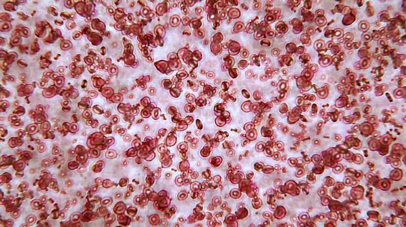 So we published a paper that said that there was a natural killer cell deficiency