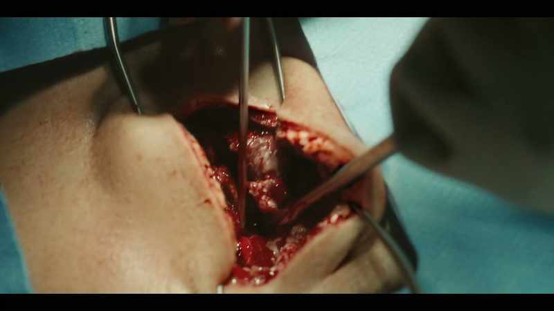 Suction. There's the ligament damage