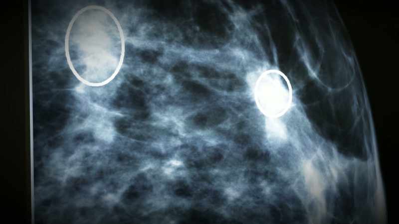 The computer has looked at 1 billion mammograms