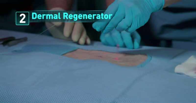 the Dermal Regenerator