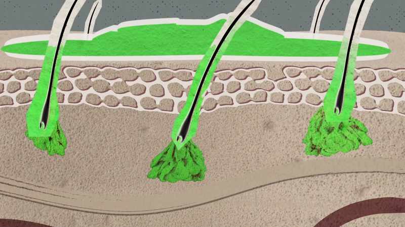The hair follicle openings