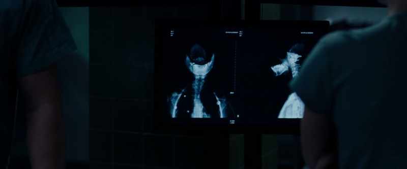 The partial decapitation was made by a circular saw