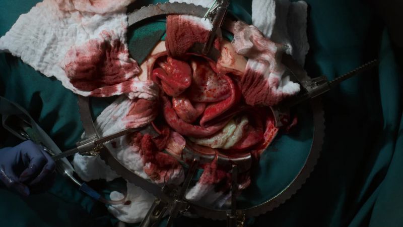 The small intestines look dusky and cyanotic