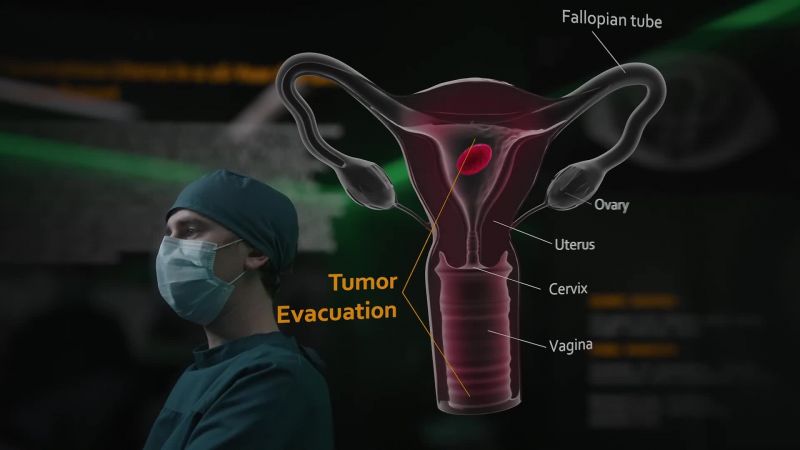 The tumor thinned her uterine wall