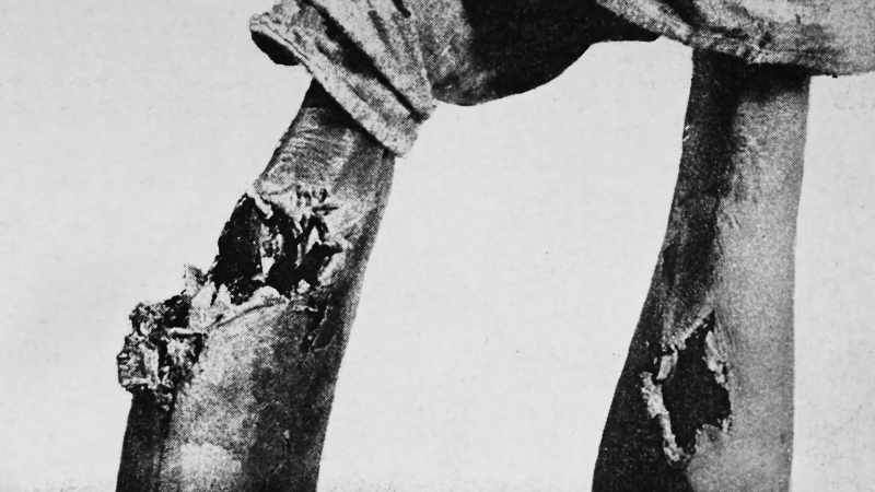 The use of dumdum bullets between civilized states